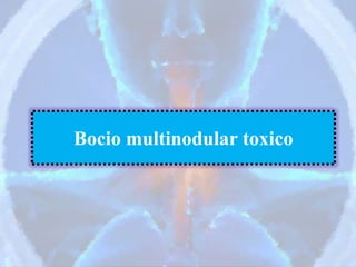 Bocio multinodular toxico
 