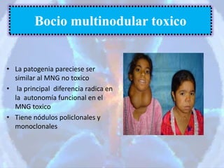 Bocio multinodular toxico
• La patogenia pareciese ser
similar al MNG no toxico
• la principal diferencia radica en
la autonomía funcional en el
MNG toxico
• Tiene nódulos policlonales y
monoclonales
 