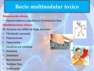 Presentación clínica:
• Hipertiroidismo subclínico o tirotoxicosis leve
Manifestaciones clínica:
Pt. Anciano con MNG de larga duración
• Fibrilación auricular
• Palpitaciones
• Taquicardia
• Insuficiencia cardiaca
• Anorexia
• Debilidad
• Nerviosismo
• Temblor fino
• Sudoración
Bocio multinodular toxico
 