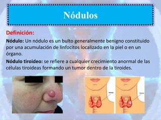 Definición:
Nódulo: Un nódulo es un bulto generalmente benigno constituido
por una acumulación de linfocitos localizado en la piel o en un
órgano.
Nódulo tiroideo: se refiere a cualquier crecimiento anormal de las
células tiroideas formando un tumor dentro de la tiroides.
Nódulos
 
