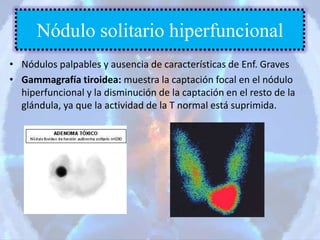 • Nódulos palpables y ausencia de características de Enf. Graves
• Gammagrafía tiroidea: muestra la captación focal en el nódulo
hiperfuncional y la disminución de la captación en el resto de la
glándula, ya que la actividad de la T normal está suprimida.
Nódulo solitario hiperfuncional
 