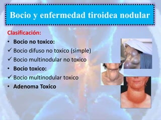 Clasificación:
• Bocio no toxico:
 Bocio difuso no toxico (simple)
 Bocio multinodular no toxico
• Bocio toxico:
 Bocio multinodular toxico
• Adenoma Toxico
Bocio y enfermedad tiroidea nodular
 