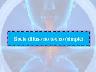 Bocio difuso no toxico (simple)
 