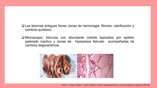  Las lesiones antiguas tienen zonas de hemorragia, fibrosis, calcificación y
cambios quísticos.
 Microscopio: folículos con abundante coloide tapizados por epitelio
aplanado inactivo y zonas de hiperplasia folicular acompañadas de
cambios degenerativos.
Kumar V, Abbas A, Nelson F.. (2010). Robbins y Cotran, Patologia estructural y funcional. Barcelona, Espana: ELSEVIER.
 