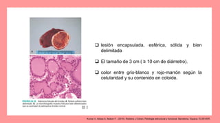  lesión encapsulada, esférica, sólida y bien
delimitada
 El tamaño de 3 cm ( ≥ 10 cm de diámetro).
 color entre gris-blanco y rojo-marrón según la
celularidad y su contenido en coloide.
Kumar V, Abbas A, Nelson F.. (2010). Robbins y Cotran, Patologia estructural y funcional. Barcelona, Espana: ELSEVIER.
 