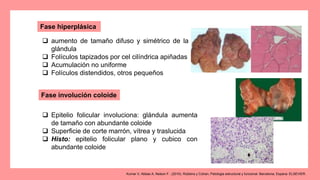 Fase hiperplásica
 aumento de tamaño difuso y simétrico de la
glándula
 Folículos tapizados por cel cilíndrica apiñadas
 Acumulación no uniforme
 Folículos distendidos, otros pequeños
 Epitelio folicular involuciona: glándula aumenta
de tamaño con abundante coloide
 Superficie de corte marrón, vítrea y traslucida
 Histo: epitelio folicular plano y cubico con
abundante coloide
Fase involución coloide
Kumar V, Abbas A, Nelson F.. (2010). Robbins y Cotran, Patologia estructural y funcional. Barcelona, Espana: ELSEVIER.
 
