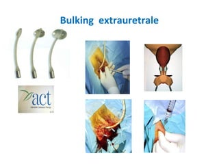 Bulking extrauretrale
 