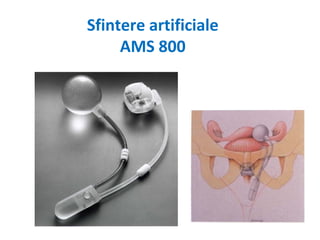 Sfintere artificiale
AMS 800
 