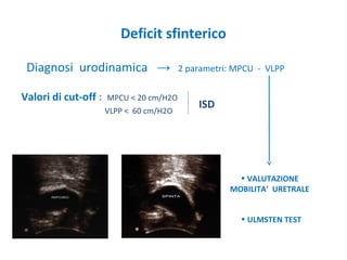 Deficit sfinterico
Diagnosi urodinamica → 2 parametri: MPCU - VLPP
Valori di cut-off : MPCU < 20 cm/H2O
VLPP < 60 cm/H2O
ISD
• VALUTAZIONE
MOBILITA’ URETRALE
• ULMSTEN TEST
 