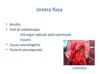 Uretra fissa
• Atrofia
• Esiti di radioterapia
chirurgia radicale pelvi-perineale
traumi
• Cause neurologiche
• Pazienti plurioperate
uretrolisi
 