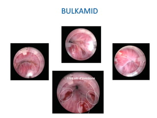 I tre siti d’iniezione
 
