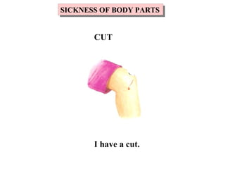 I have a cut.
SICKNESS OF BODY PARTSSICKNESS OF BODY PARTS
CUT
 