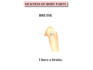 I have a bruise.
SICKNESS OF BODY PARTSSICKNESS OF BODY PARTS
BRUISE
 
