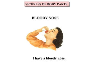 I have a bloody nose.
SICKNESS OF BODY PARTSSICKNESS OF BODY PARTS
BLOODY NOSE
 