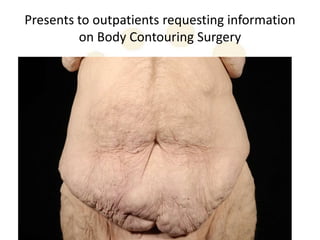 Presents to outpatients requesting information
         on Body Contouring Surgery
 