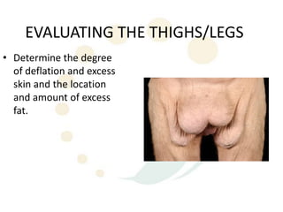 EVALUATING THE THIGHS/LEGS
• Determine the degree
  of deflation and excess
  skin and the location
  and amount of excess
  fat.
 