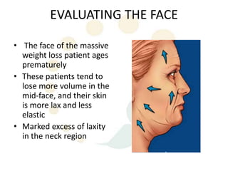 EVALUATING THE FACE

• The face of the massive
  weight loss patient ages
  prematurely
• These patients tend to
  lose more volume in the
  mid-face, and their skin
  is more lax and less
  elastic
• Marked excess of laxity
  in the neck region
 