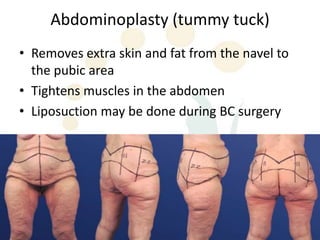 Abdominoplasty (tummy tuck)
• Removes extra skin and fat from the navel to
  the pubic area
• Tightens muscles in the abdomen
• Liposuction may be done during BC surgery
 