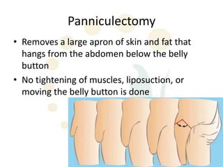 Panniculectomy
• Removes a large apron of skin and fat that
  hangs from the abdomen below the belly
  button
• No tightening of muscles, liposuction, or
  moving the belly button is done
 