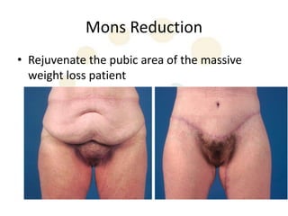 Mons Reduction
• Rejuvenate the pubic area of the massive
  weight loss patient
 