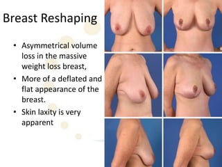 Breast Reshaping
 • Asymmetrical volume
   loss in the massive
   weight loss breast,
 • More of a deflated and
   flat appearance of the
   breast.
 • Skin laxity is very
   apparent
 