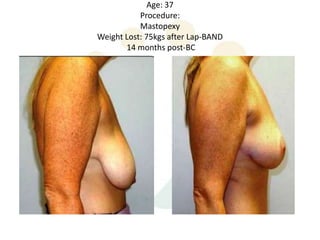 Age: 37
           Procedure:
           Mastopexy
Weight Lost: 75kgs after Lap-BAND
       14 months post-BC
 
