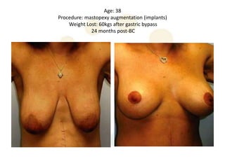 Age: 38
Procedure: mastopexy augmentation (implants)
    Weight Lost: 60kgs after gastric bypass
             24 months post-BC
 