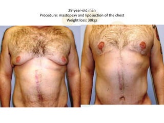28-year-old man
Procedure: mastopexy and liposuction of the chest
               Weight loss: 30kgs
 