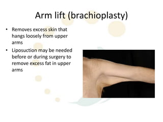 Arm lift (brachioplasty)
• Removes excess skin that
  hangs loosely from upper
  arms
• Liposuction may be needed
  before or during surgery to
  remove excess fat in upper
  arms
 