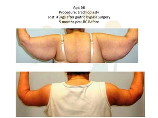 Age: 58
       Procedure: brachioplasty
Lost: 45kgs after gastric bypass surgery
       5 months post-BC Before
 