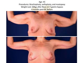 Age: 45
Procedures: Brachioplasty, axilloplasty, and mastopexy
  Weight Lost: 60kgs after Roux-en-Y gastric bypass
              4 months post-BC Before
 