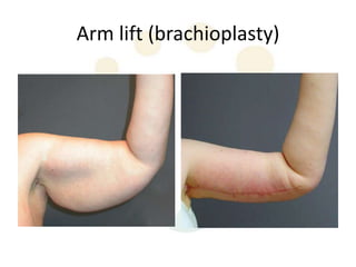 Arm lift (brachioplasty)
 