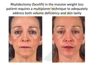 Rhytidectomy (facelift) in the massive weight loss
patient requires a multiplaner technique to adequately
    address both volume deficiency and skin laxity
 