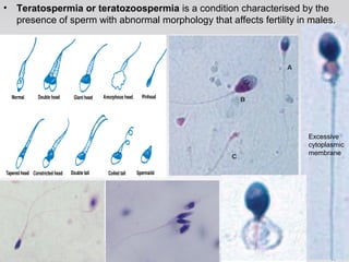 • Teratospermia or teratozoospermia is a condition characterised by the 
presence of sperm with abnormal morphology that affects fertility in males. 
Excessive 
cytoplasmic 
membrane 
 