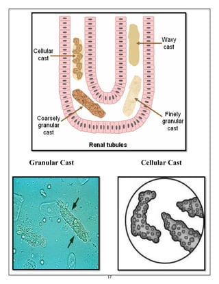 Cellular Cast Example Urine Analysis and Kidney function tests | PDF
