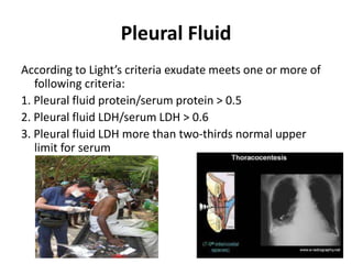 Pleural Fluid
According to Light’s criteria exudate meets one or more of
following criteria:
1. Pleural fluid protein/serum protein > 0.5
2. Pleural fluid LDH/serum LDH > 0.6
3. Pleural fluid LDH more than two-thirds normal upper
limit for serum
 