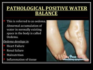 PATHOLOGICAL POSITIVE WATER
BALANCE
 This is referred to as oedema.
Abnormal accumulation of
water in normally existing
space in the body is called
Oedema.
Oedema develops in
 Heart Failure
 Renal failure
 Malnutrition
 Inflammation of tissue
 
