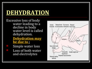 DEHYDRATION
Excessive loss of body
water leading to a
decline in body
water level is called
dehydration.
Dehydration may
be due to :
 Simple water loss
 Loss of both water
and electrolytes
 