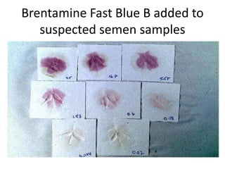 Brentamine Fast Blue B added to
suspected semen samples
 