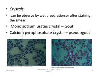 • Crystals
• can be observe by wet preparation or after staining
the smear
• Mono sodium urates crystal – Gout
• Calcium pyrophosphate crystal – pseudogout
10/13/2018 36
SUNIL KUMAR.P ST.JOHN'S MEDICAL
COLLEGE
 