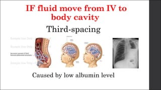 IF fluid move from IV to
body cavity
Third-spacing
Caused by low albumin level
 