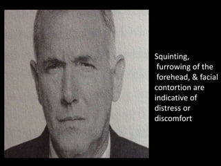 Squinting,
furrowing of the
forehead, & facial
contortion are
indicative of
distress or
discomfort
 