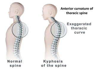 Anterior curvature of
thoracic spine
 