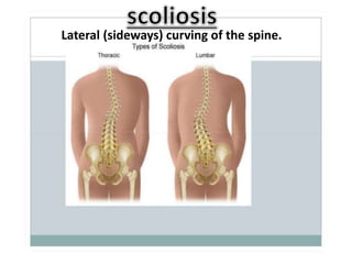 Lateral (sideways) curving of the spine.
 