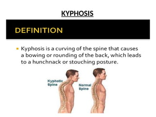 KYPHOSIS
 