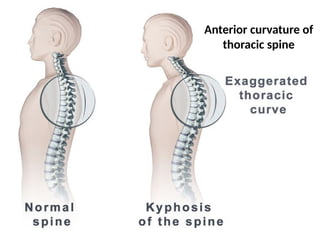 Anterior curvature of
thoracic spine
 