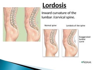 Lordosis
Inward curvature of the
lumbar /cervical spine.
 