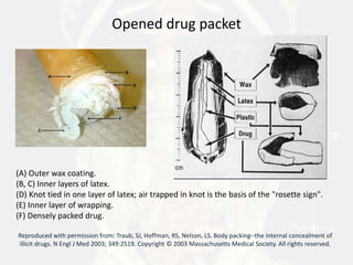 Body packers | PPT