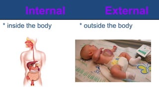 Internal External
* outside the body
* inside the body
 