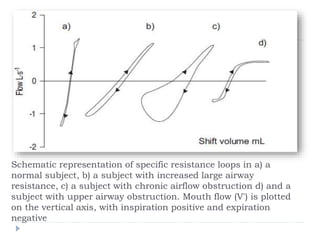 Schematic representation of specific resistance loops in a) a
normal subject, b) a subject with increased large airway
resistance, c) a subject with chronic airflow obstruction d) and a
subject with upper airway obstruction. Mouth flow (V') is plotted
on the vertical axis, with inspiration positive and expiration
negative
 